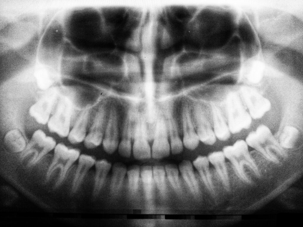 risks of wisdom tooth vaping
